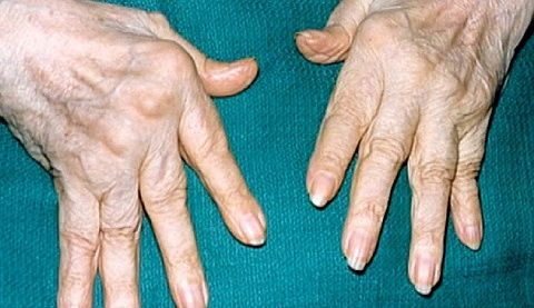 Біль у суглобах пальців рук