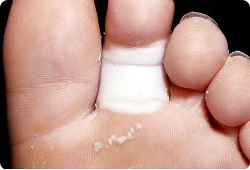 Причини переломів пальців стопи