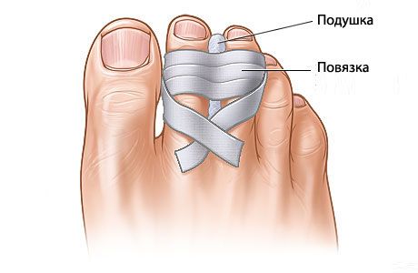 Які перспективи відновлення зламаних пальців ніг?