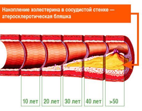 З'ясовано, які атеросклеротичні бляшки винні в інсульті