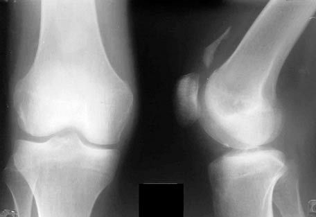 Рентген колінного суглоба
