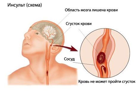 Легкий тест пророкує інсульт зі смертельними наслідками