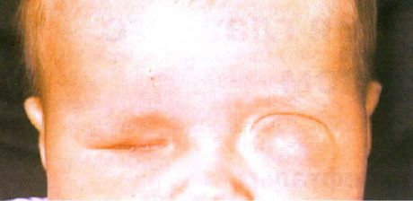 Мікрофтальм з супутнім кістообразованіе (ліве око).  Анофтальм (праве око).
