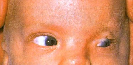 Синдром Фрейзера.  Неповний кріптофтальм лівого ока.