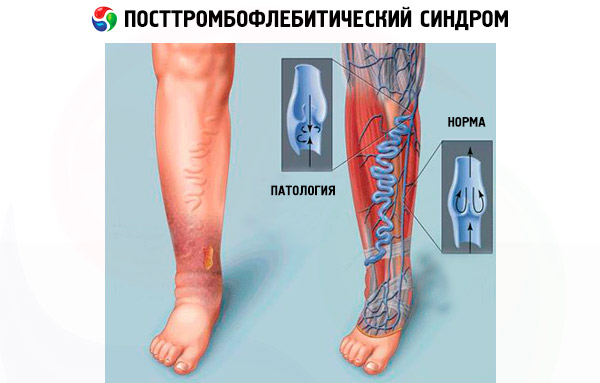 Тромбоз студфайл. Посттромбофлебитический синдром. Трофическая язва. ПТФС вен нижних конечностей. Варикозное расширение вен нижних конечностей ХВН.