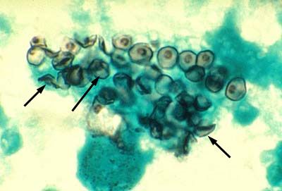 Збудник пневмоцистозу (Pneumocystis jiroveci)