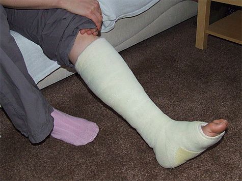 Заходи в домашніх умовах при переломі ніг