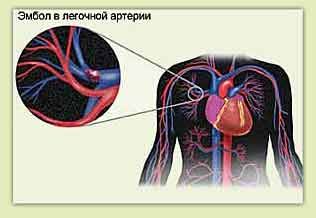 Легенева емболія і і болю в грудях зліва