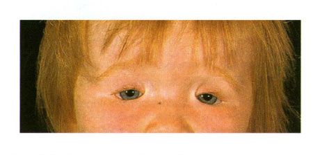 Двостороння колобома століття у дитини з синдромом Гольденара.  Незмикання очної щілини зліва