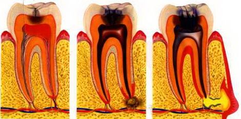 Зубний біль після пломбування 